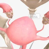 PCOS (PMOS)